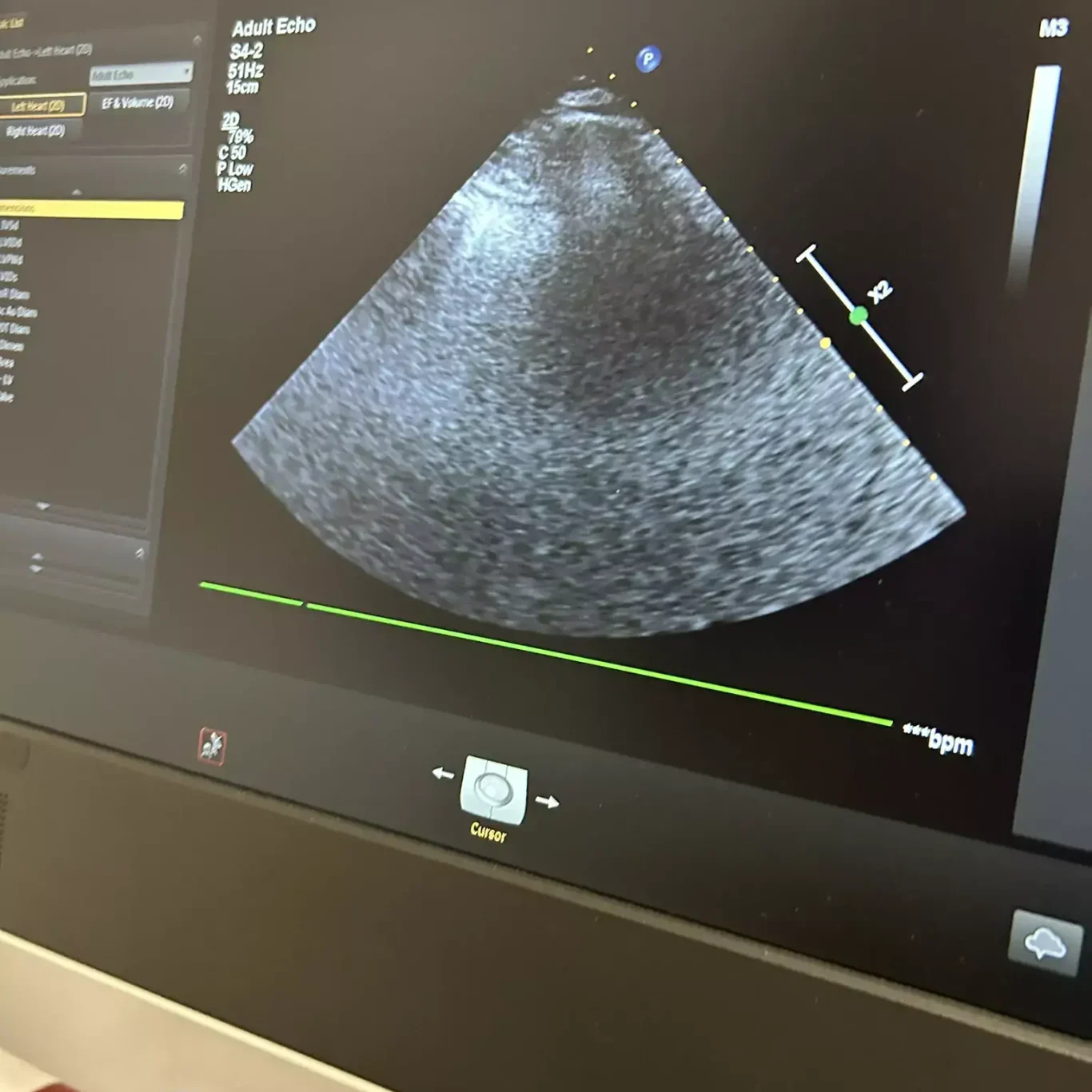 Ecografie cardiacă la cabinet cardiologic din Brașov