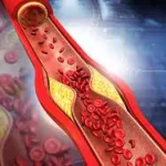 Ateroscleroza - depuneri de plăci de grăsime pe pereții arterelor, afectând circulația sângelui