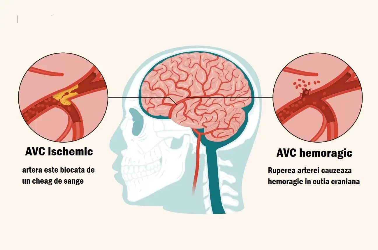 Tipuri de accident vascular cerebral: ischemic și hemoragic, explicate vizual