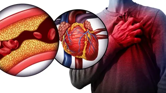 Simptome asociate cu boli cardiovasculare – ingustarea arterelor si durerea toracica