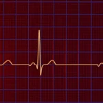 ilustrație medicală despre aritmia cardiacă, cauze, simptome și tratamente