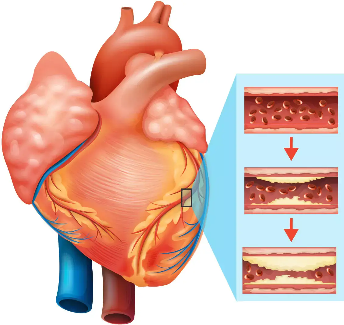Ilustrație a inimii și a arterelor cu depuneri de colesterol – factori de risc cardiovascular