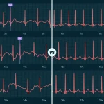 Electrocardiogramă care compară un ritm cardiac normal cu fibrilația atrială