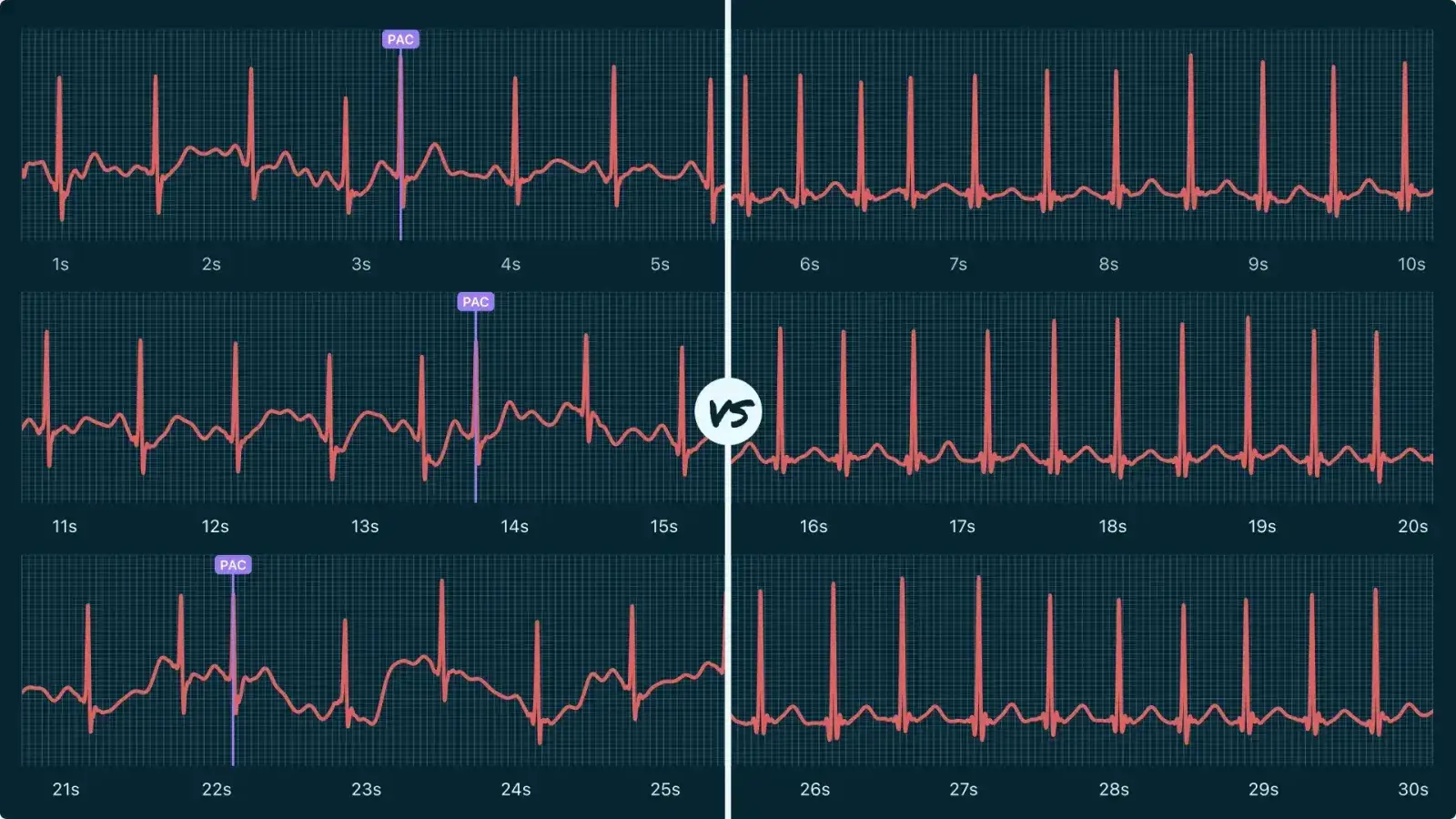 Electrocardiogramă care compară un ritm cardiac normal cu fibrilația atrială