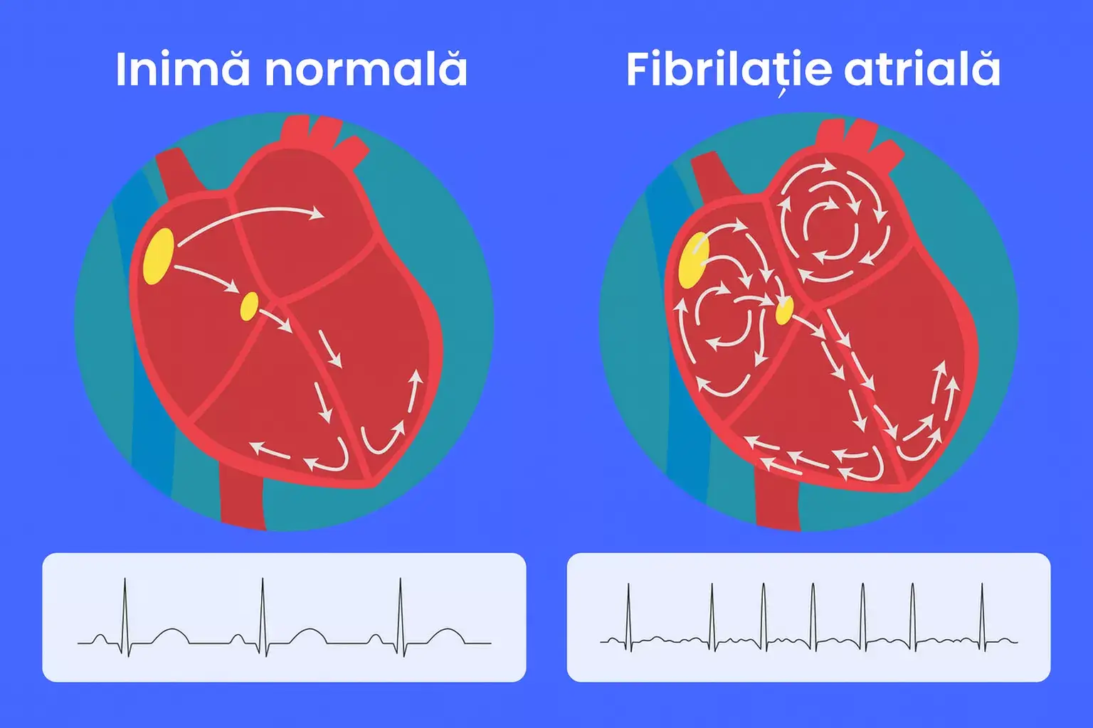 Diferența dintre o inimă normală și o inimă cu fibrilația atrială, ilustrând ritmul cardiac neregulat