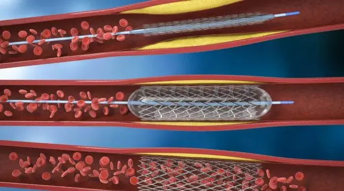 Diagramă secțiune arterială coronariană cu stent plasat pentru a deschide o arteră îngustată de ateroscleroză și a restabili fluxul sanguin