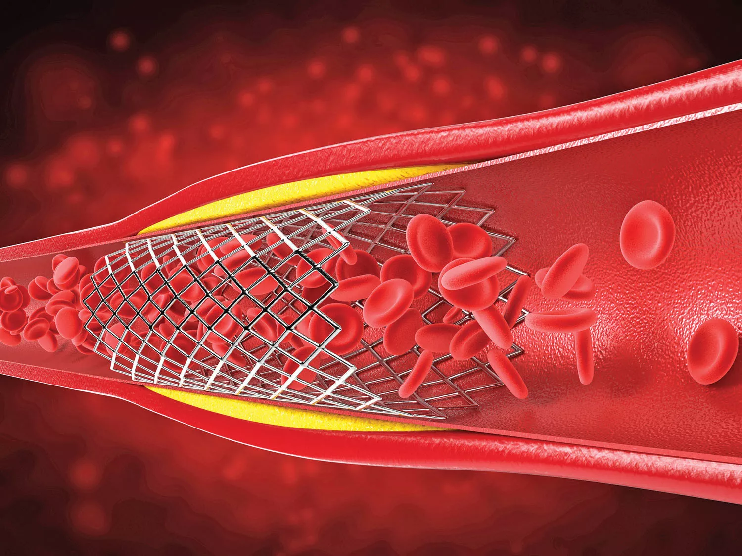 Risc de stent la colesterol si tensiune usor crescuta