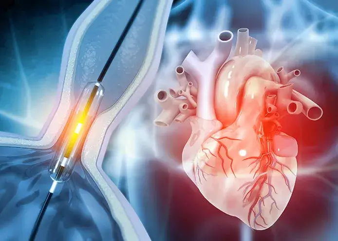 Monitorizare cardiologică după angioplastie – prevenirea complicațiilor post-stent