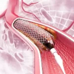 Pacient după angioplastie coronariană – importanța tratamentului post-stent