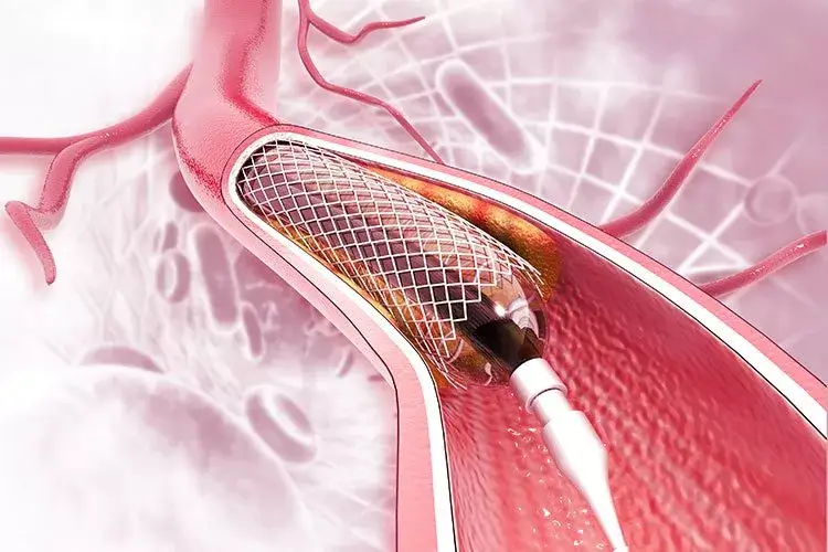 Pacient după angioplastie coronariană – importanța tratamentului post-stent