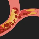 Hipercolesterolemia familială, cauză genetică a colesterolului mare și a infarctului miocardic precoce.