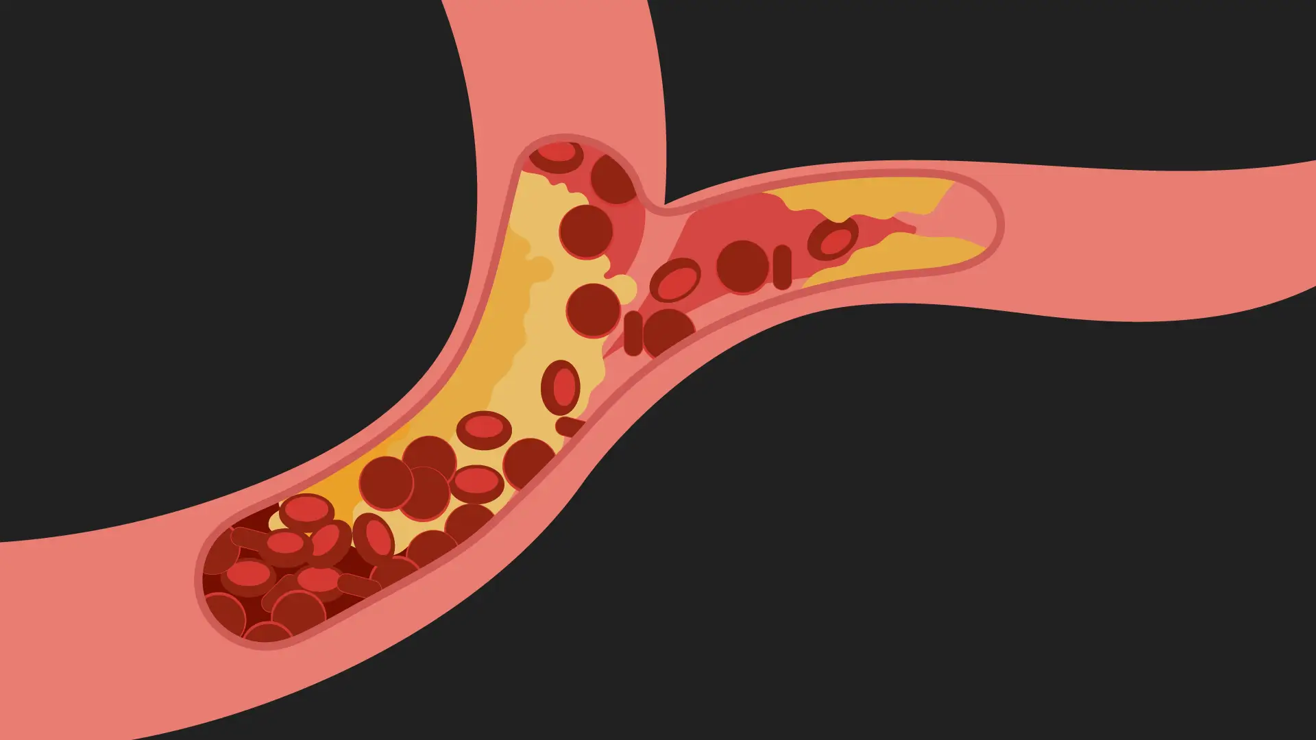 Hipercolesterolemia familială, cauză genetică a colesterolului mare și a infarctului miocardic precoce.