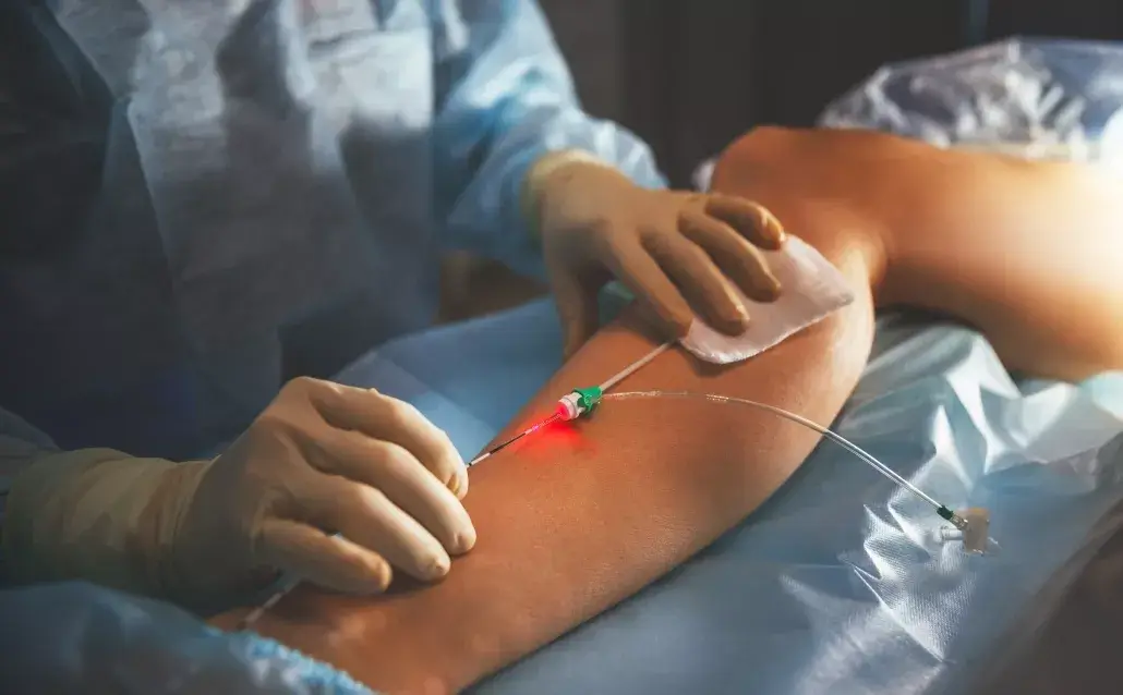 Procedură de ablație endovenoasă utilizată pentru tratamentul modern al varicelor.