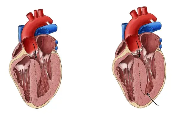 Cardiomiopatie hipertrofică obstructivă cu îngroșarea peretelui ventriculului stâng.