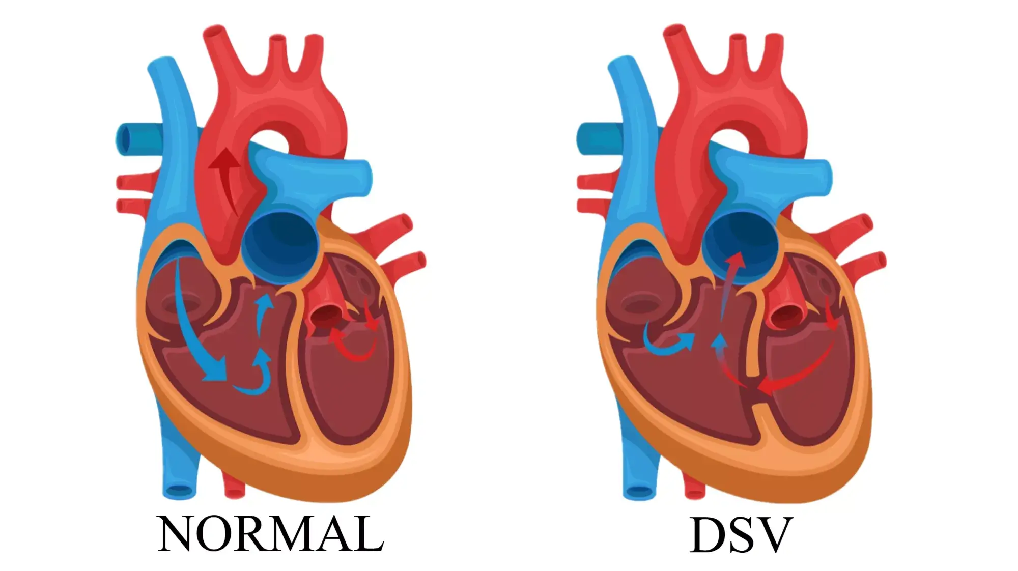 Defect septal ventricular cu comunicare între ventriculul stâng și ventriculul drept.