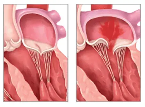 Insuficiență mitrală cu reflux de sânge prin valva mitrală în timpul sistolei.