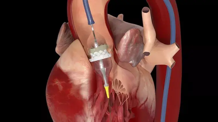 Procedură TAVI pentru înlocuirea valvei aortice la un pacient cu stenoză aortică severă.