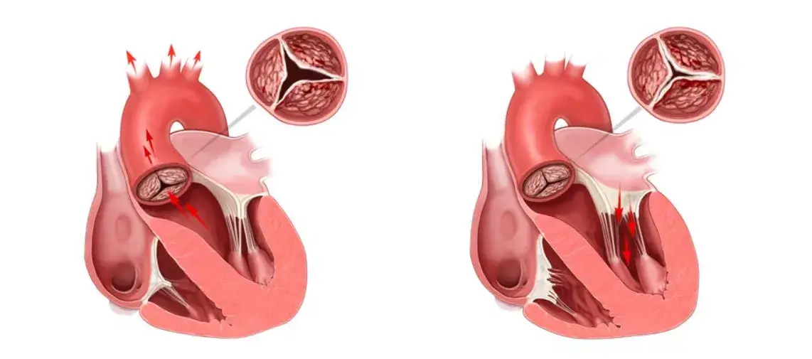 Valvă aortică îngustată în stenoza aortică și modificarea fluxului sanguin prin inimă.