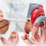 Suflu sistolic la inimă ilustrat prin flux sanguin turbulent la nivelul valvelor cardiace.