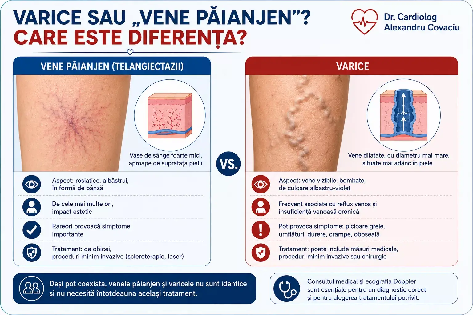 Comparație între varice și vene păianjen, evidențiind diferențele de aspect și dimensiune.