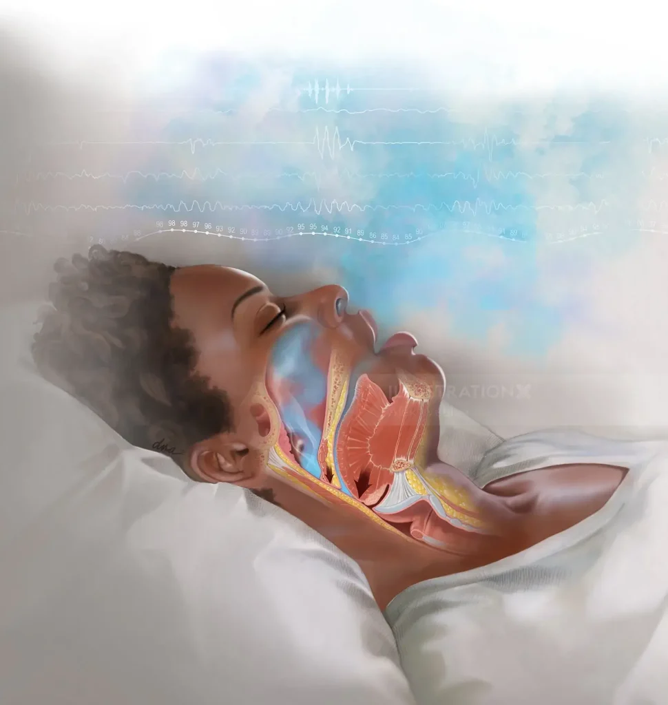 Apneea de somn și inima – ilustrație care arată oprirea temporară a respirației în timpul somnului.