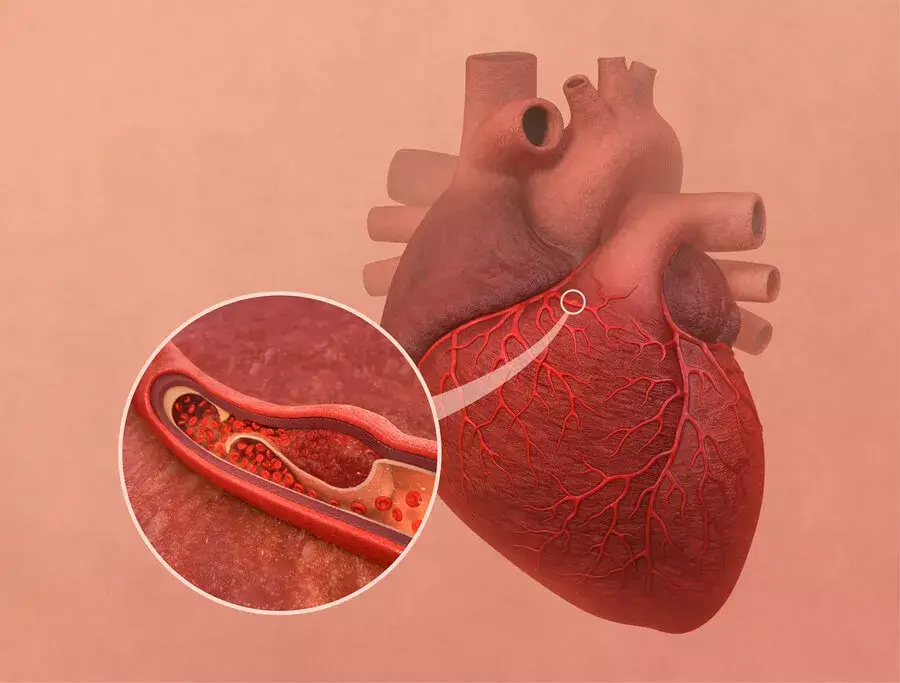 Infografic care prezintă disecția spontană de arteră coronară (SCAD), o cauză de infarct la femei tinere