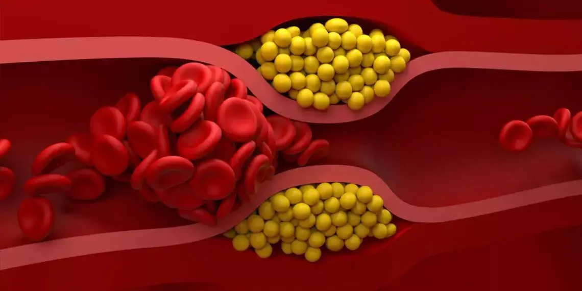 Trigliceride crescute asociate cu HDL scazut intr-un infografic medical