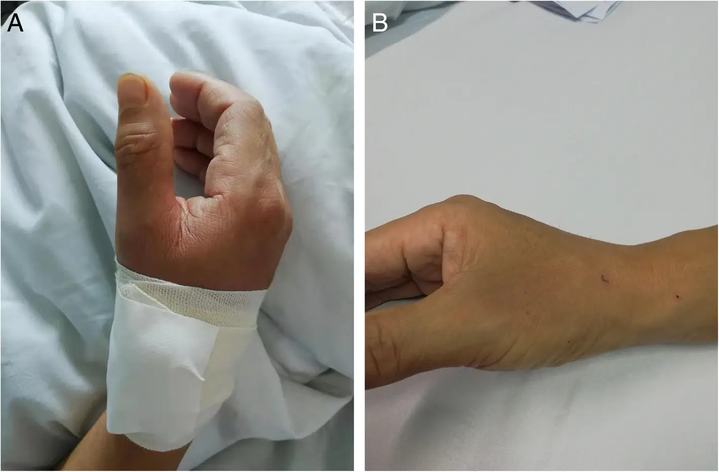 Recuperarea după coronarografie prin acces radial