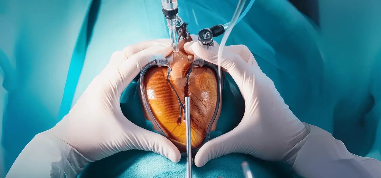 Recuperare cardiacă după stent și protejarea inimii