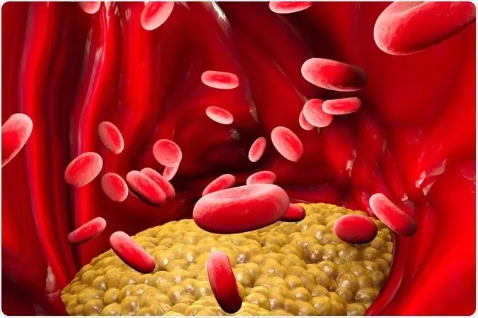 Trigliceridele crescute - cauze, riscuri cardiovasculare si opțiuni de tratament