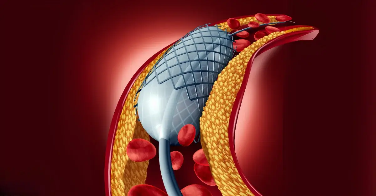 Infografic cu stent coronarian după angioplastie