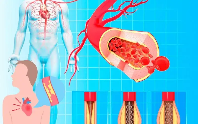 Arteră cu ateroscleroză înainte și după implantarea unui stent